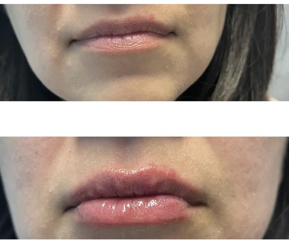 Lip Fillers Or Smile Line Fillers