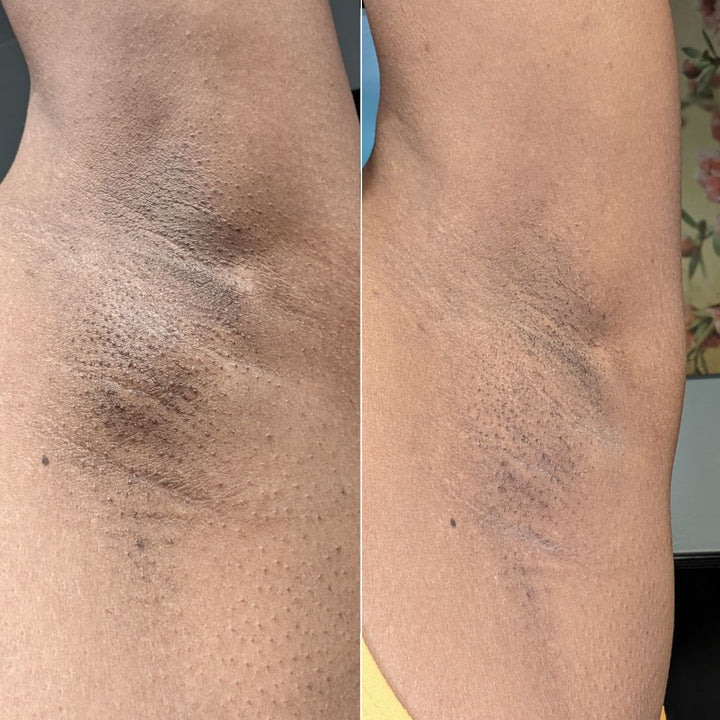 Under Arm + Thigh Treatment at Unspoken Beauty Aesthetics in Port Saint Lucie, FL