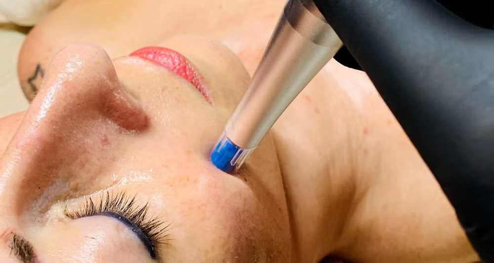 Rezenerate  Nano  Infusion  Facial