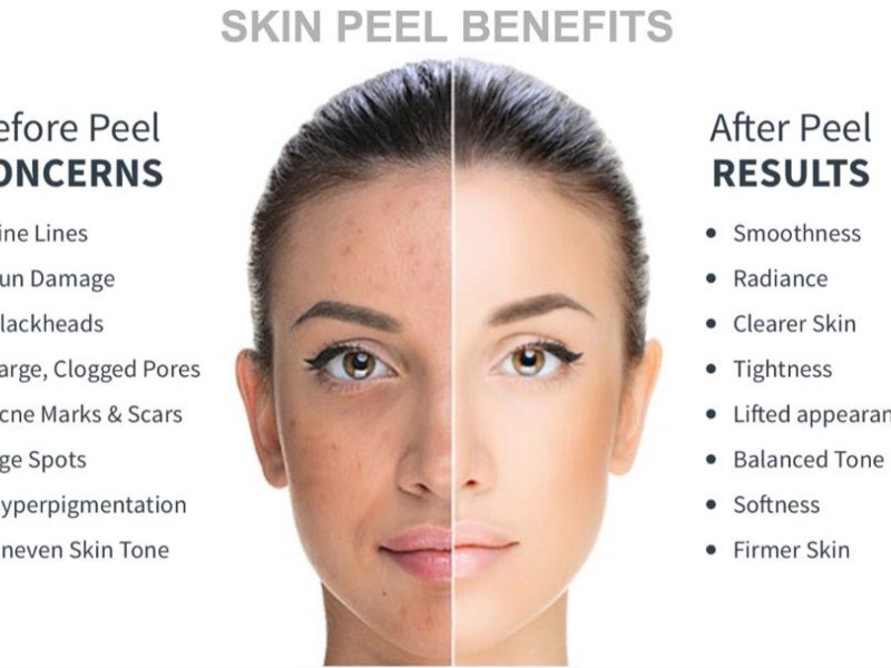 TRANSITION PEEL