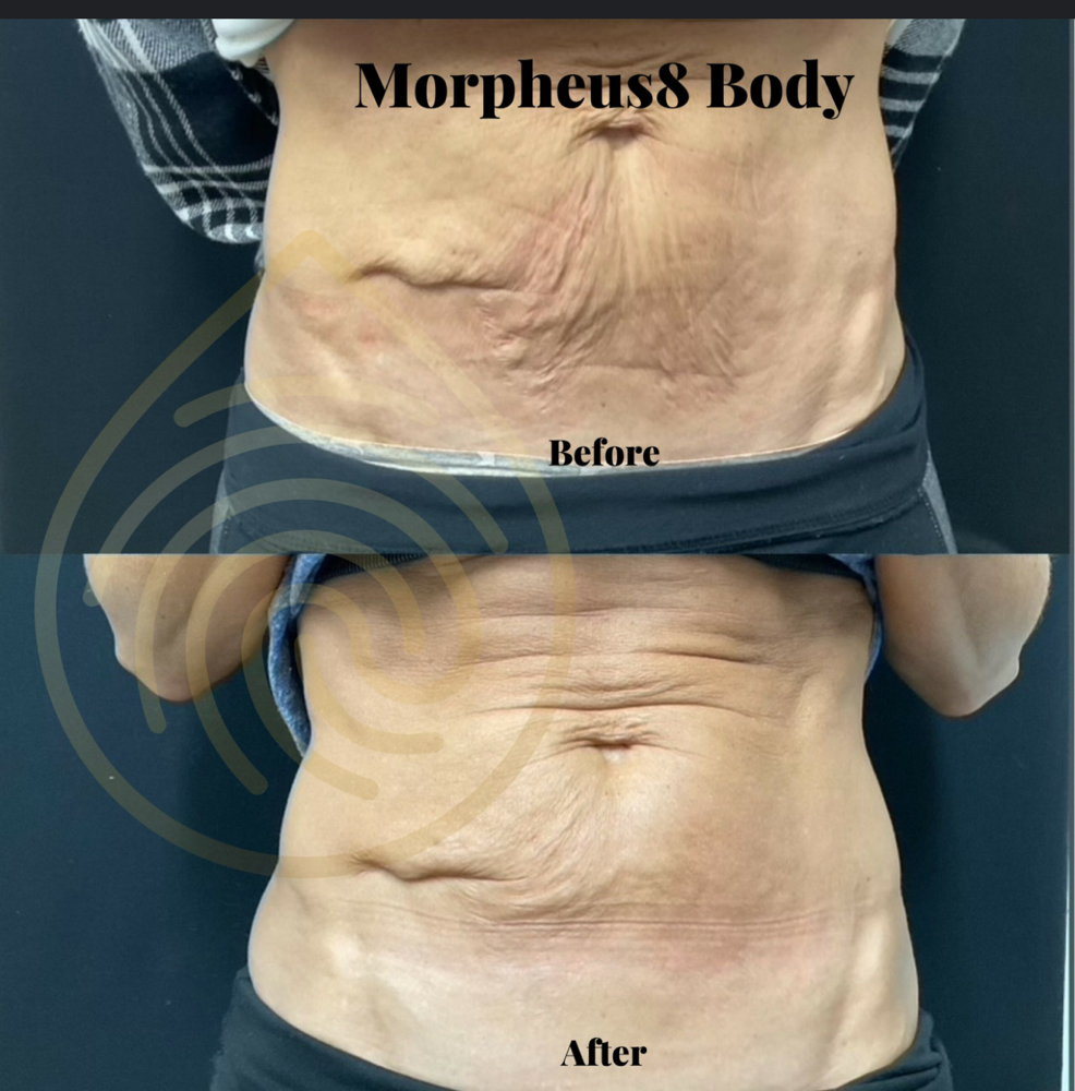 Morpheus Body (Large Area)