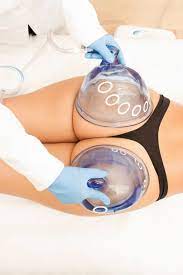 NON Invasive Butt lift at Ascent Artistry Studio - The Beauty Collective in Roanoke, VA