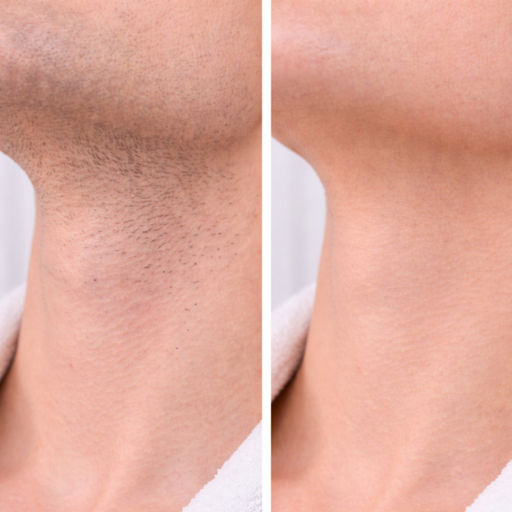 Neck Laser Hair Removal