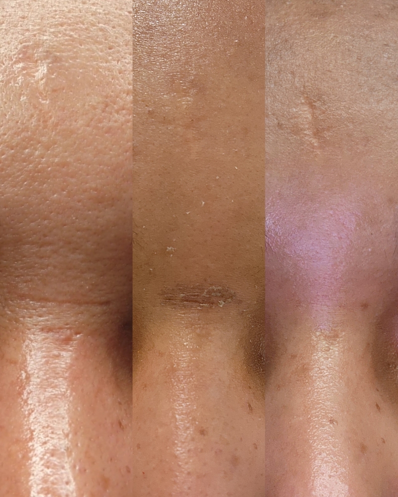 Microneedling Collagen + Stem Cells