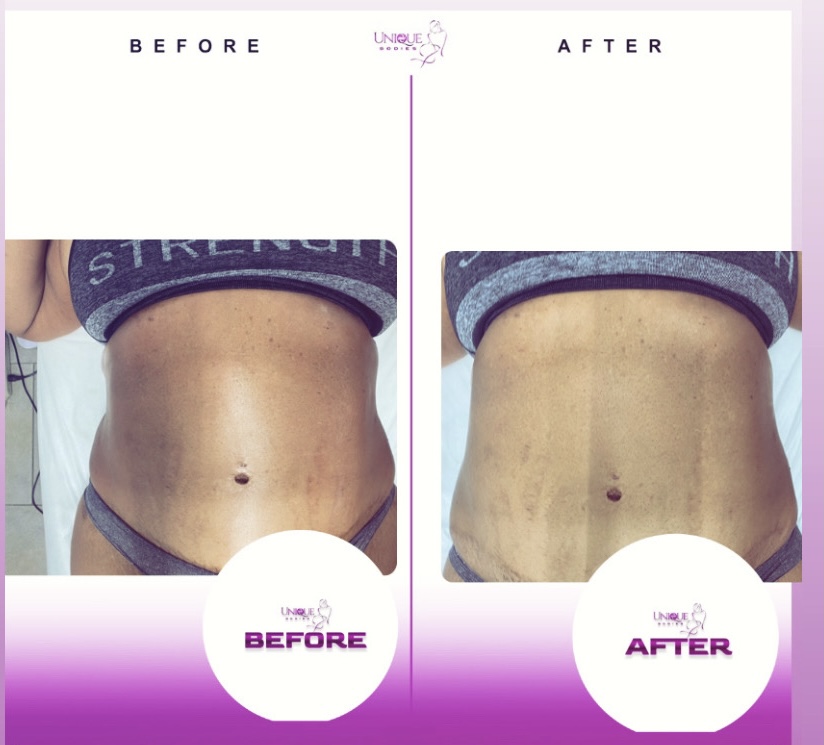 Radiofrequency Skin Tightening