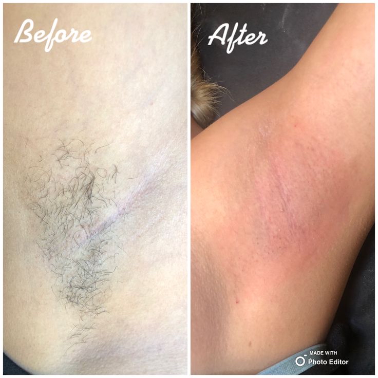 Under Arm Wax