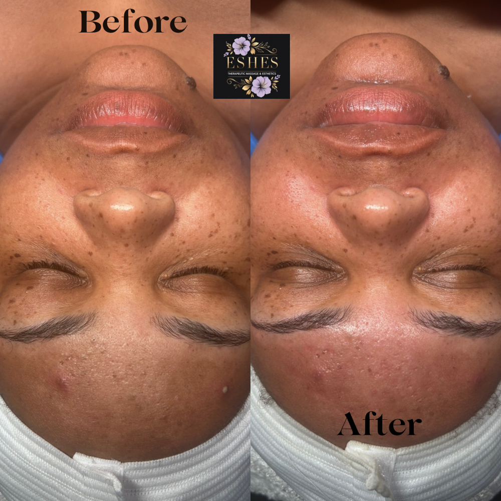 Microdermabrasion Facial