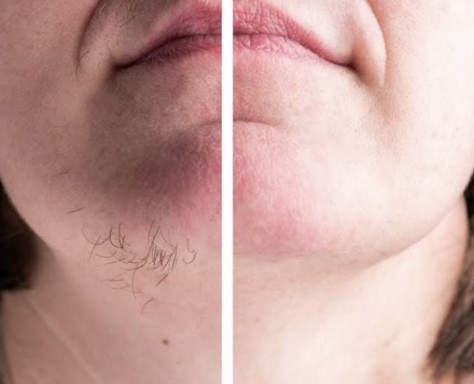 Chin/Lip Wax