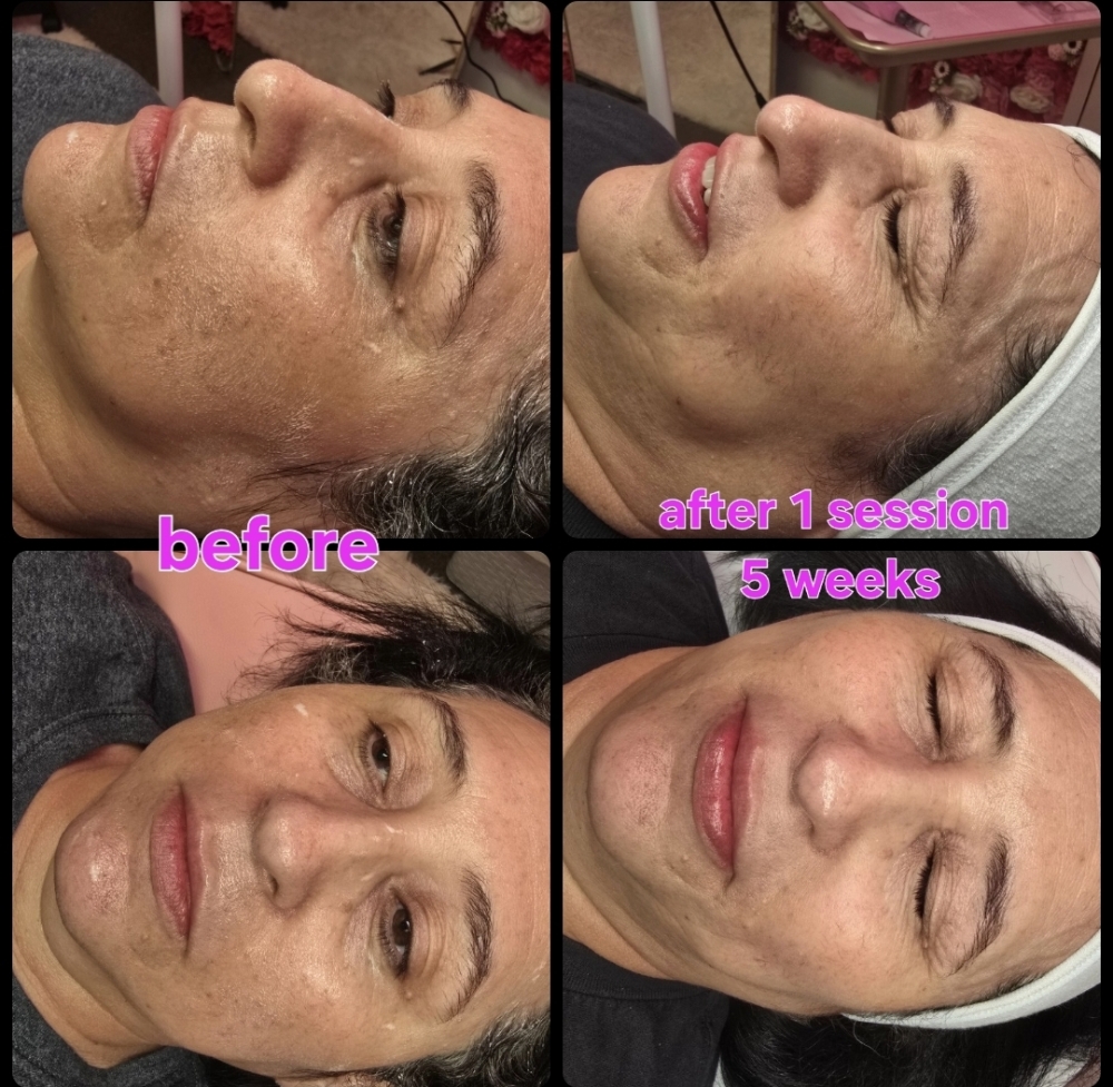 Vamp X Microneedling