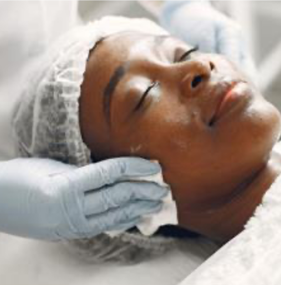 Chemical Peel