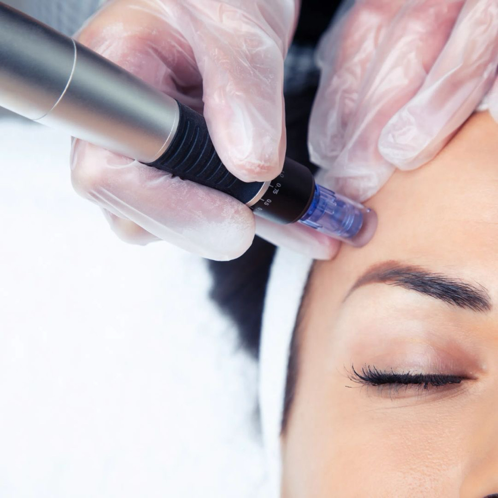 Nano Needling Facial 🖋️ at SoLeRi Esthetics. “Your Skin, Your Story.” in Lewisville, TX