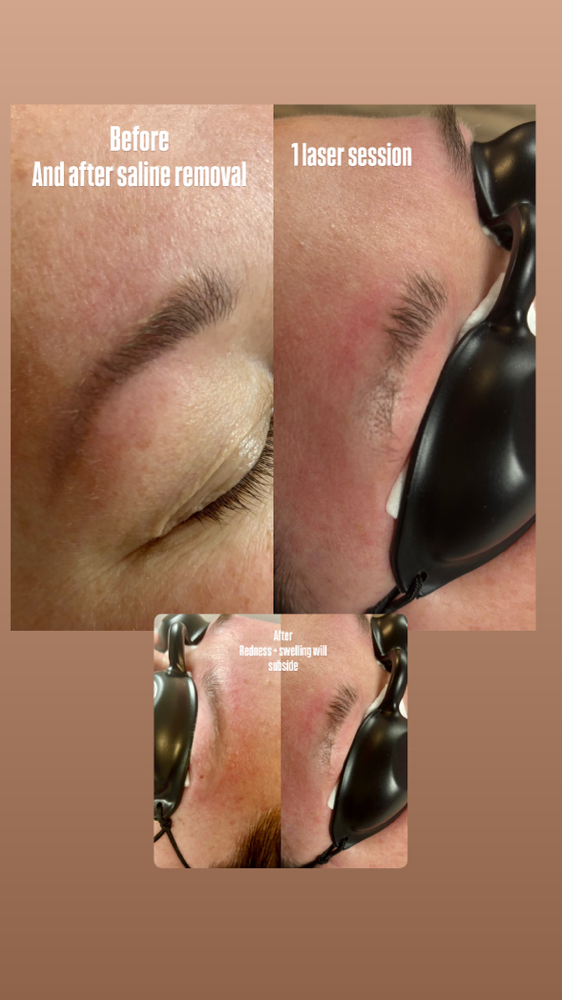 Consult Laser Brow/ Lip / Freckle