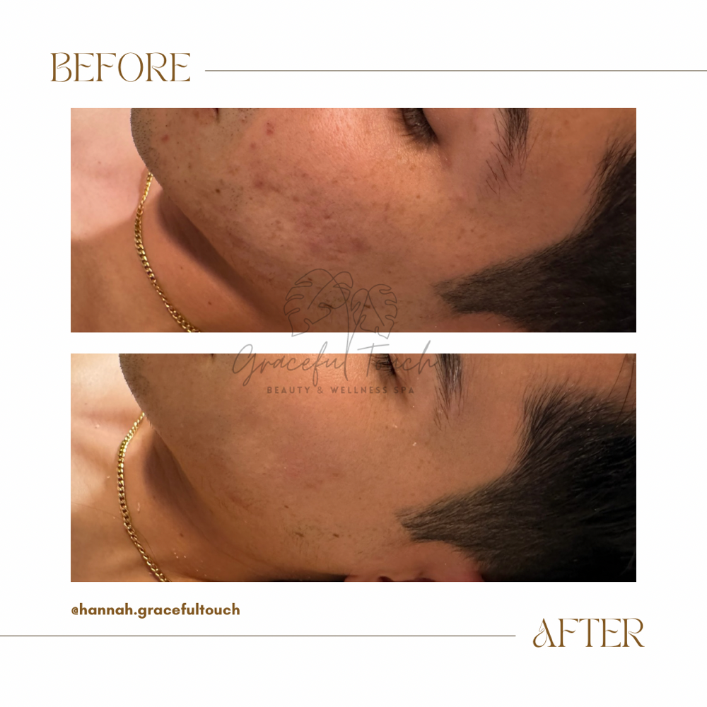 Graceful Acne Advanced