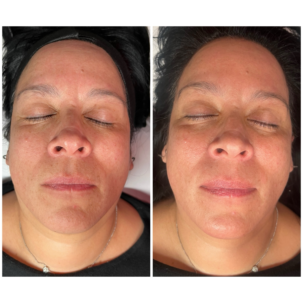 Dermaplaning Facial