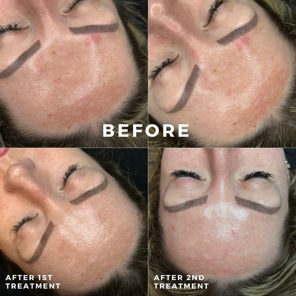 Lazer Peel Facial