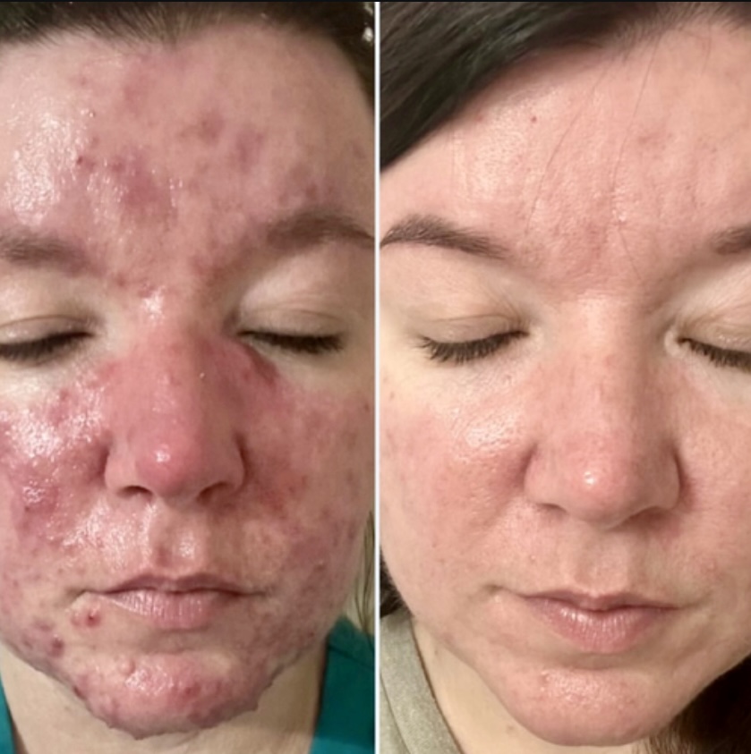 Acne Healing Consult