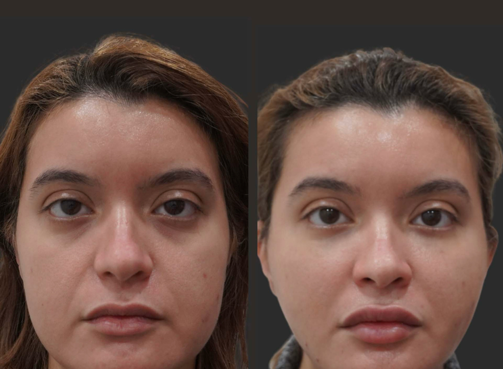Cheek Filler