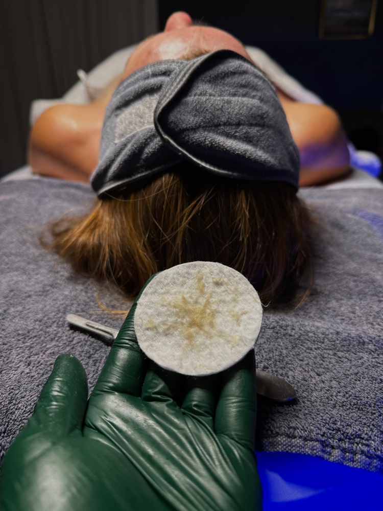 Dermaplane at MadSkin Esthetics in Colorado Springs, CO