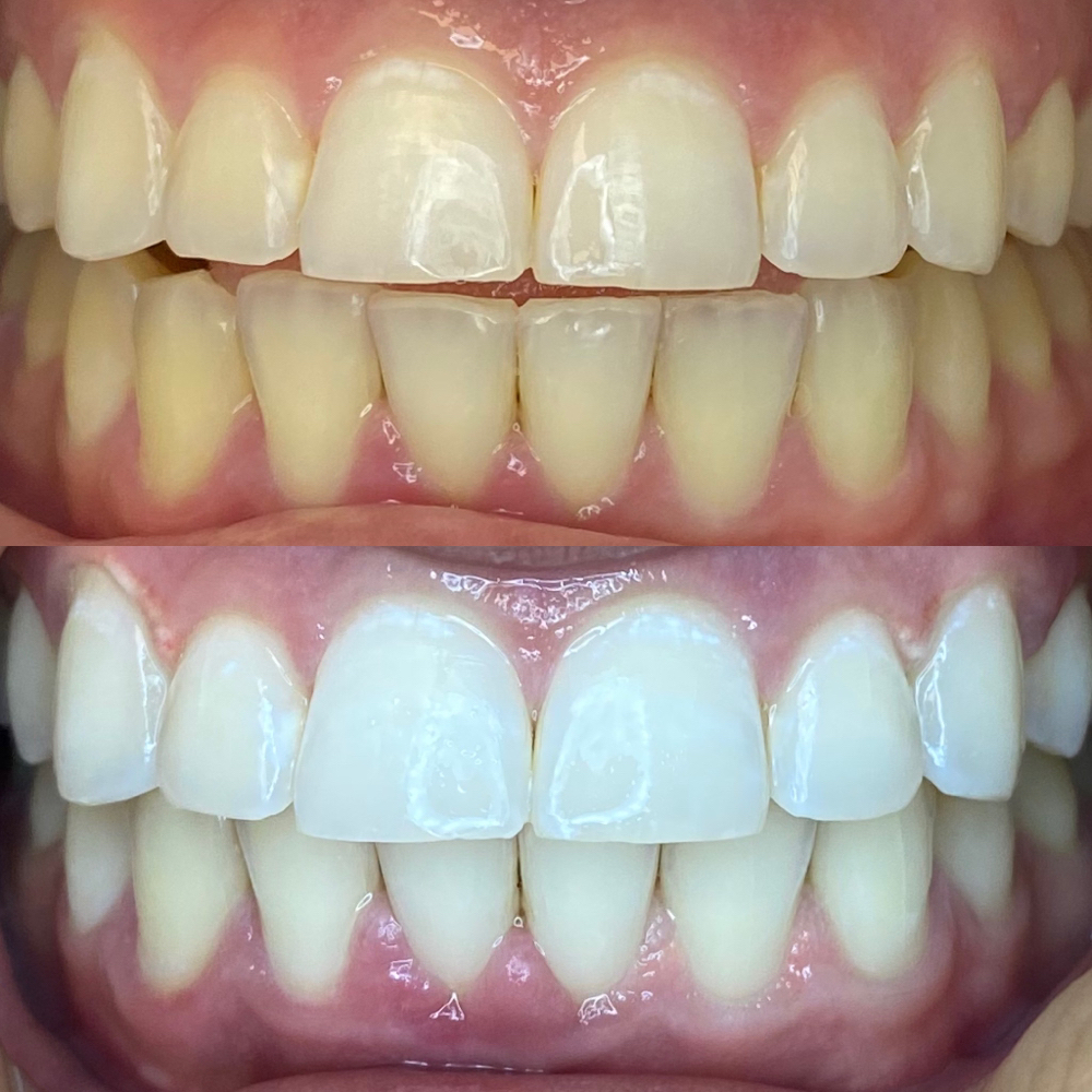90 Minute Teeth Whitening