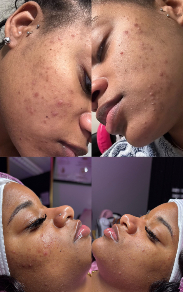 Acne Rx