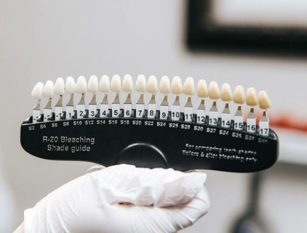 ✨Teeth Whitening✨