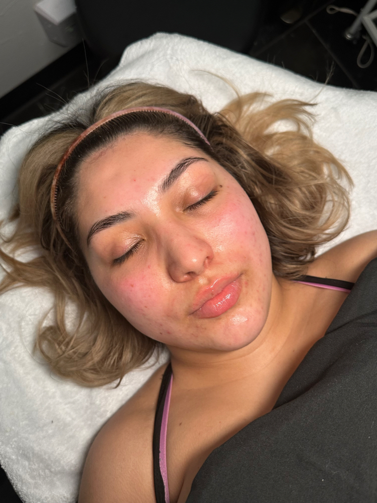 Micro Infusion Facial