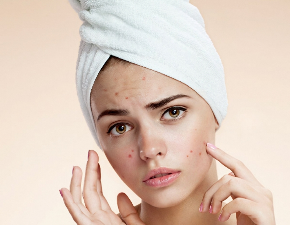 Corrective Acne Facial