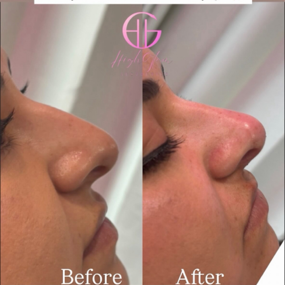 Liquid Rhinoplasty at HighGlam Aesthetics in Houston, TX