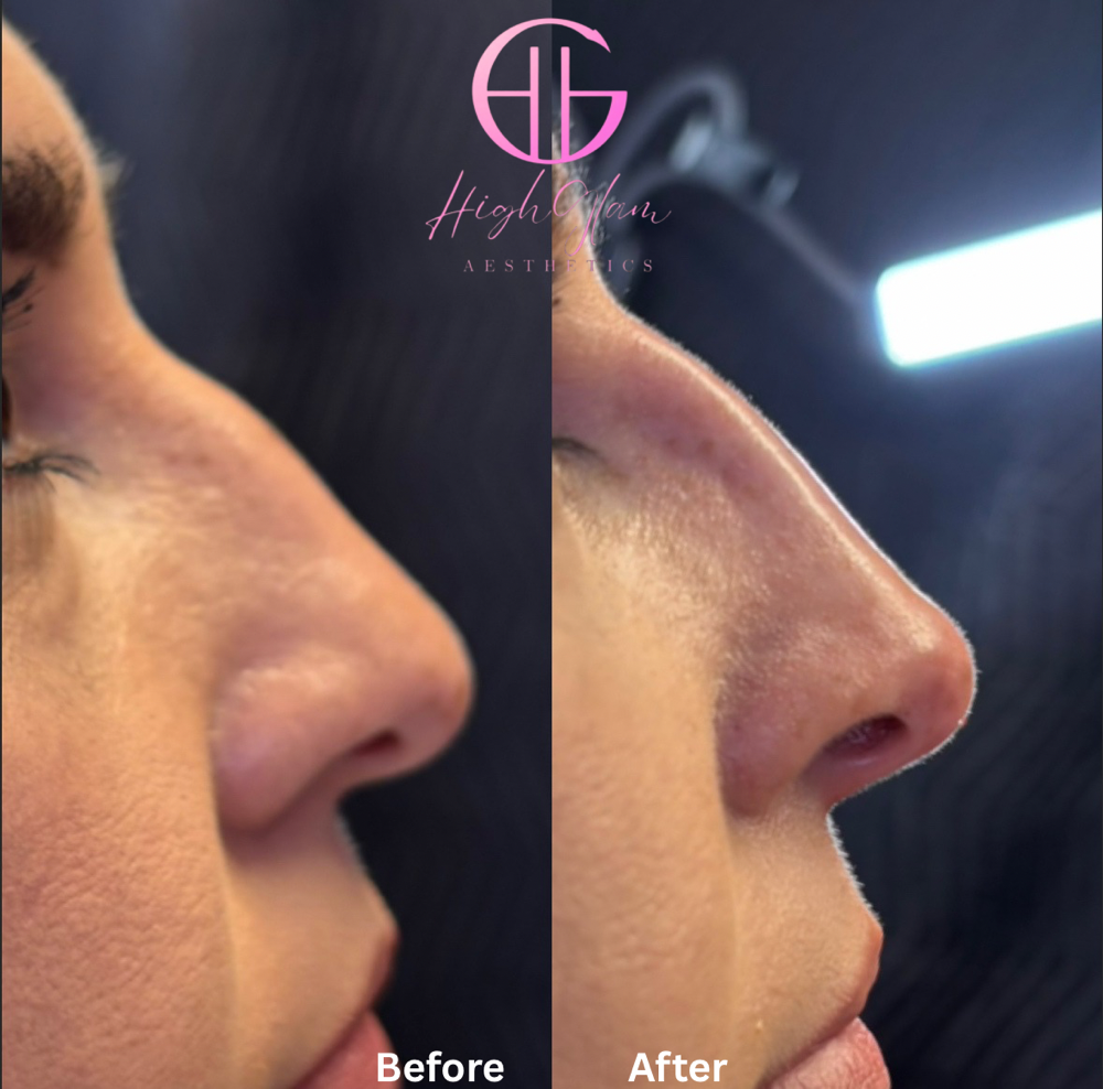 Liquid Rhinoplasty