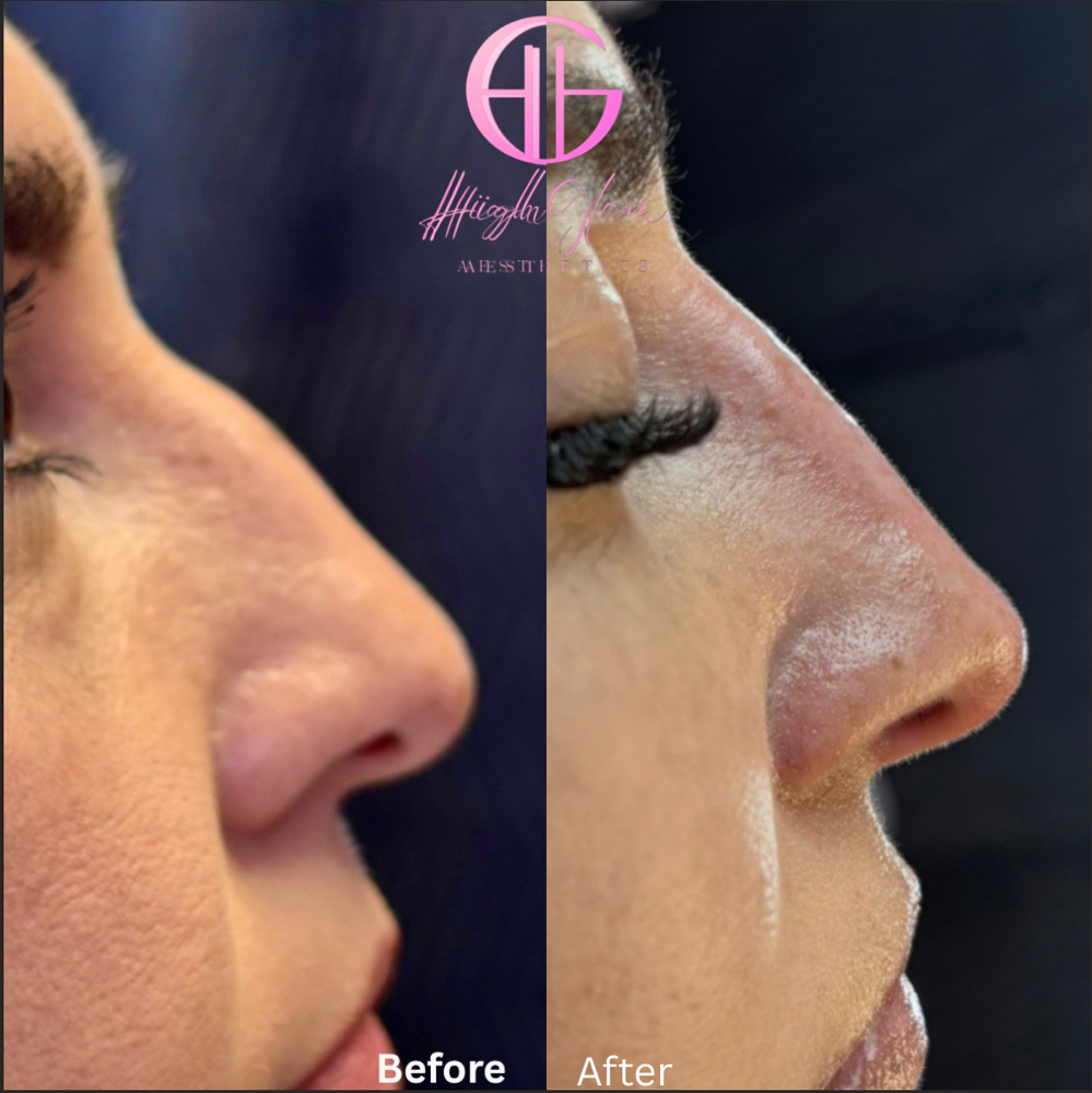 Liquid Rhinoplasty