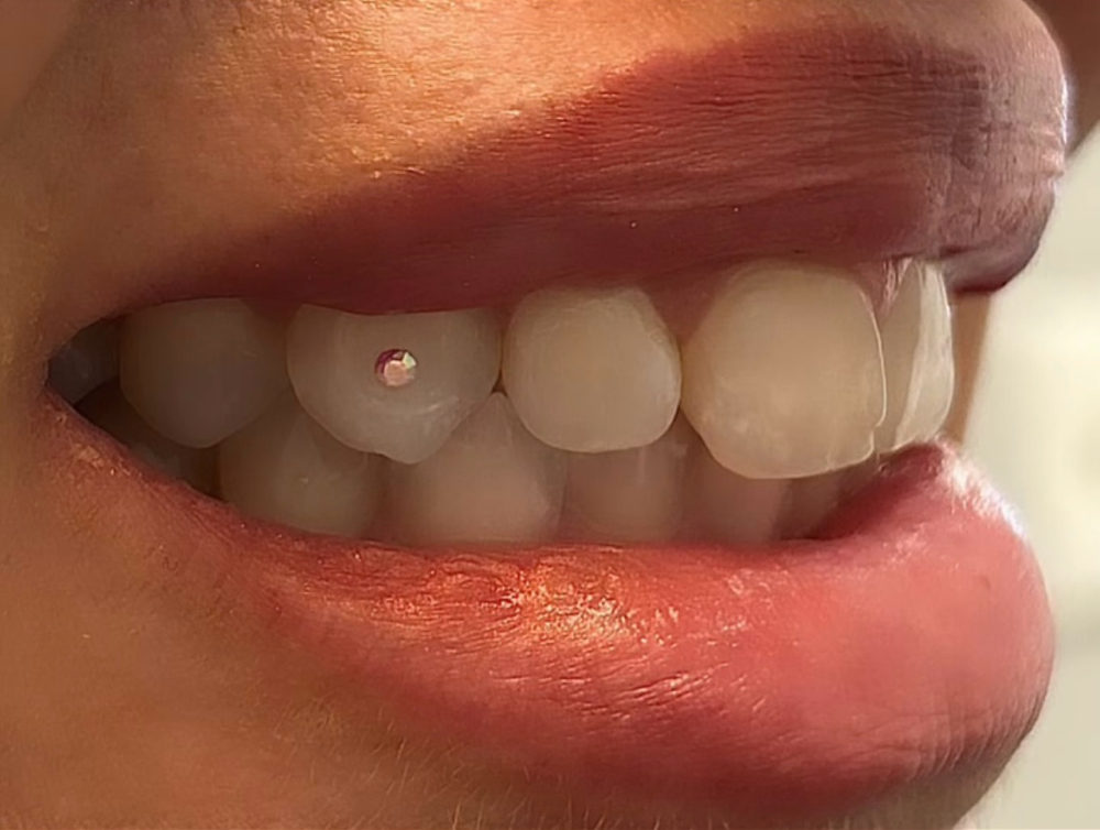 Tooth Gems