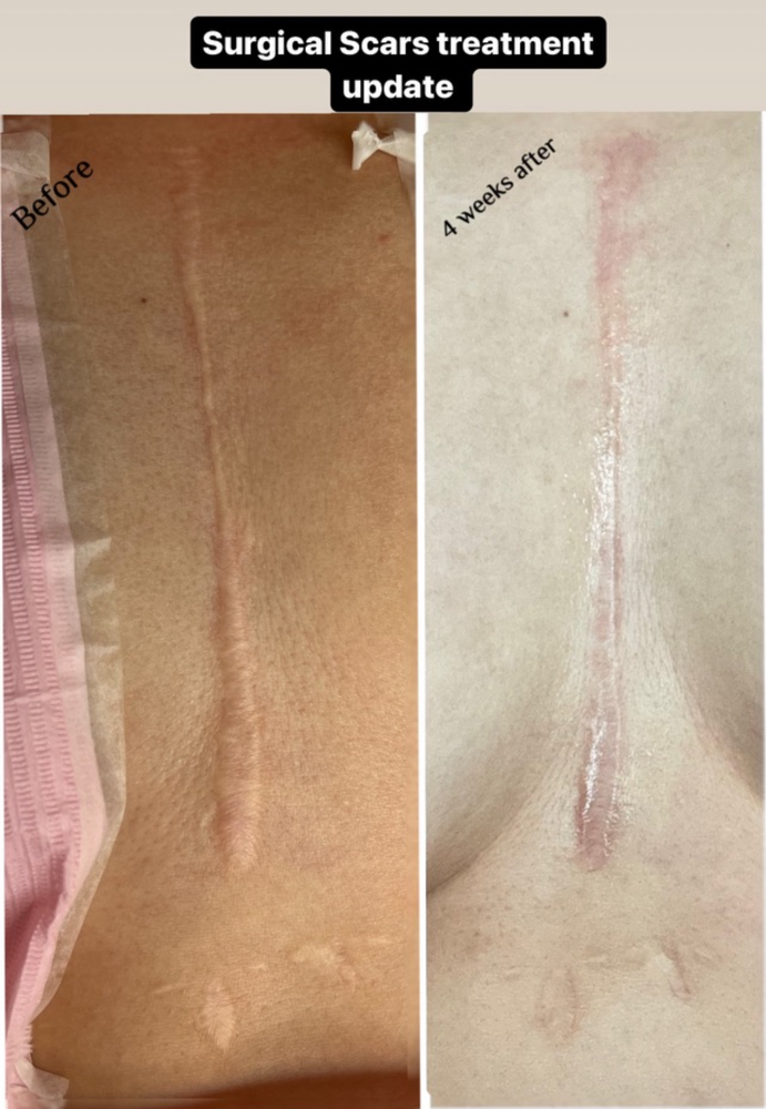 Scar Rejuvenation Treament