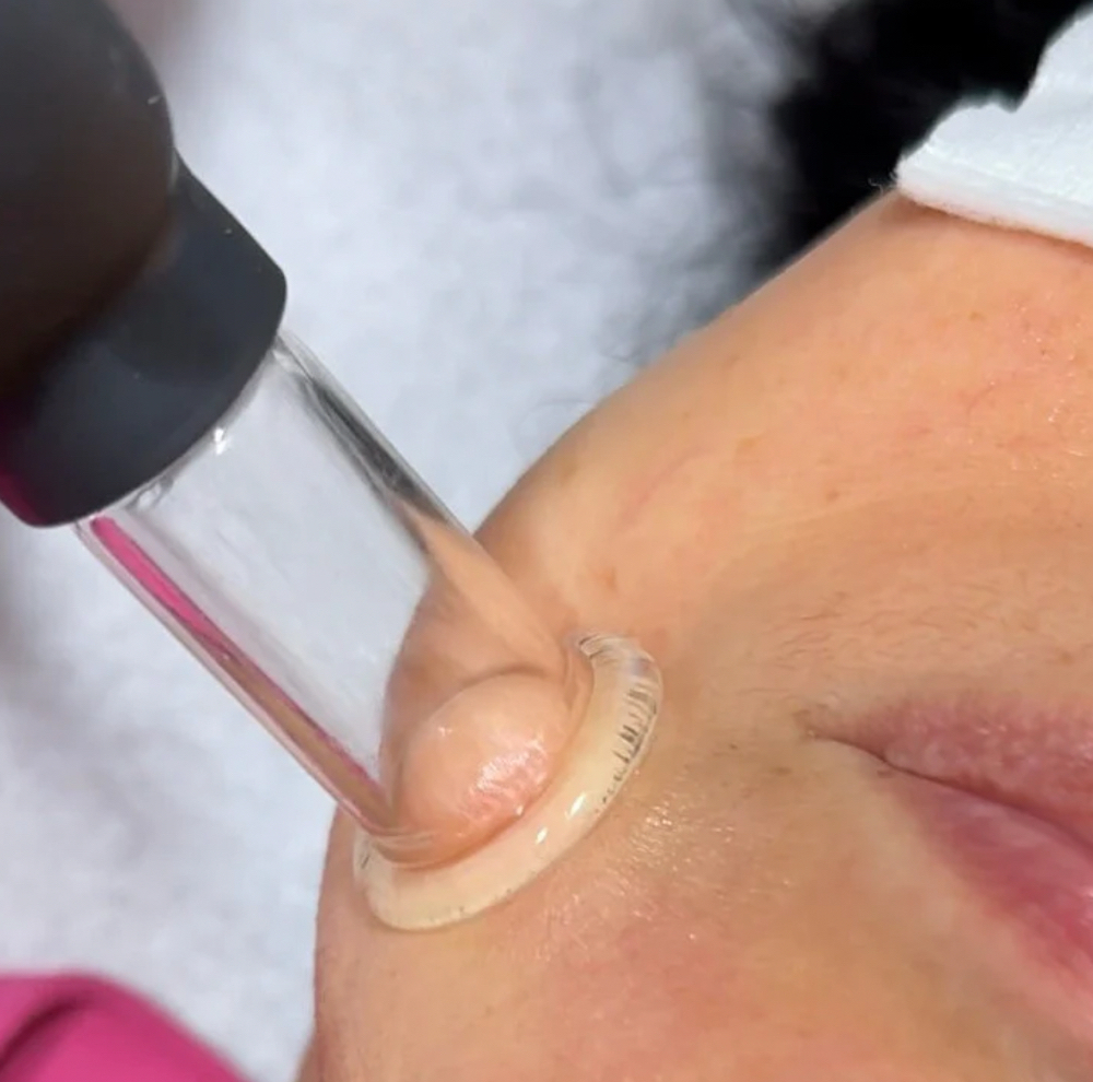 Facial Cupping at Starlin Girl Esthetics in Nevada, MO