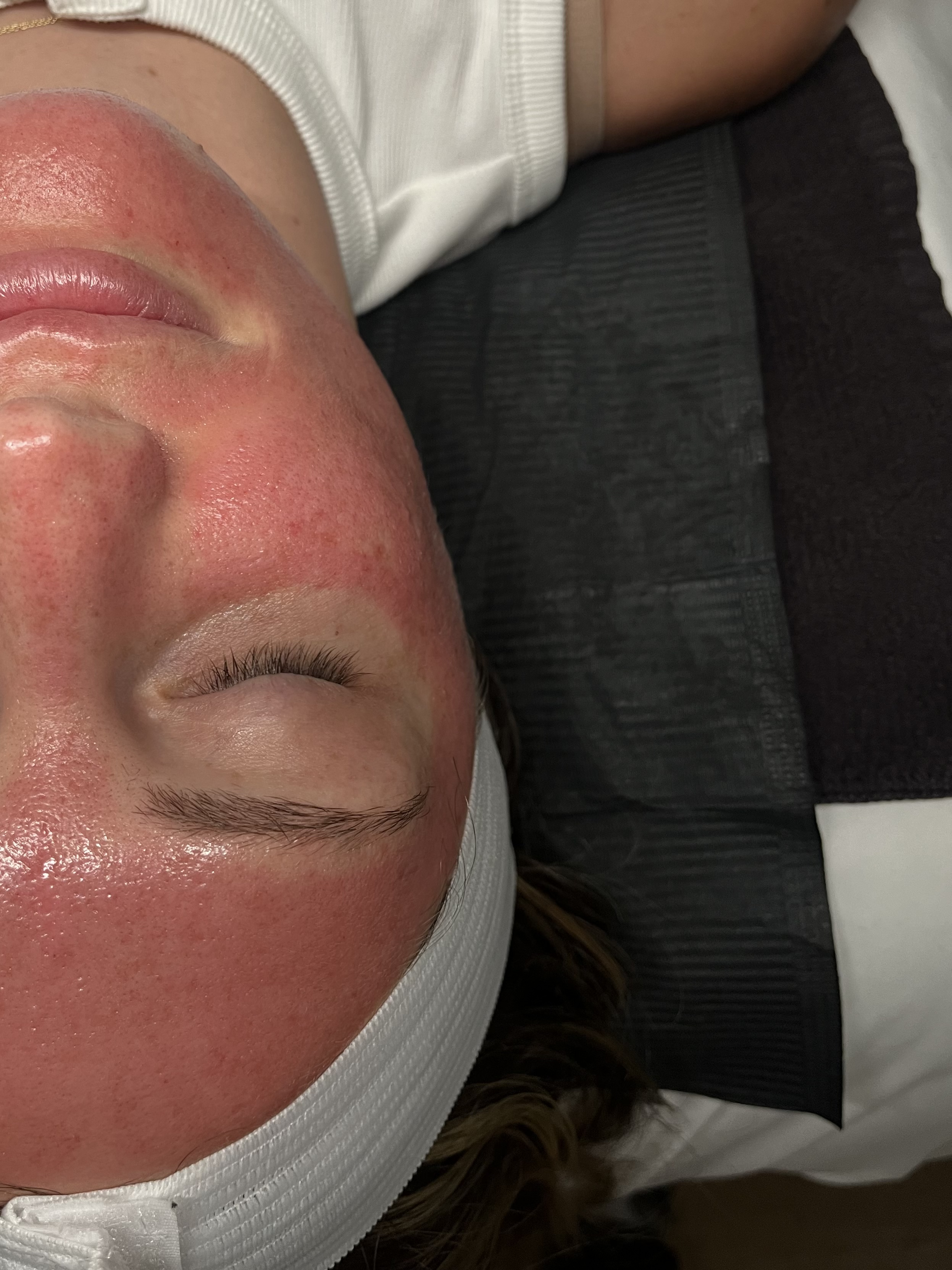 Microneedling