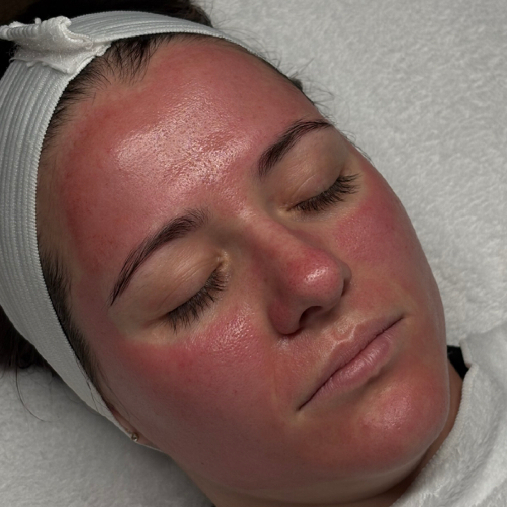 SkinPen Microneedling at Sunday Skincare in Las Vegas, NV