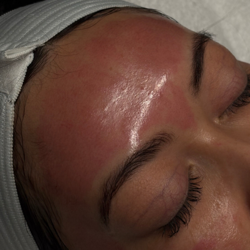 Microneedling at Sunday Skincare in Las Vegas, NV