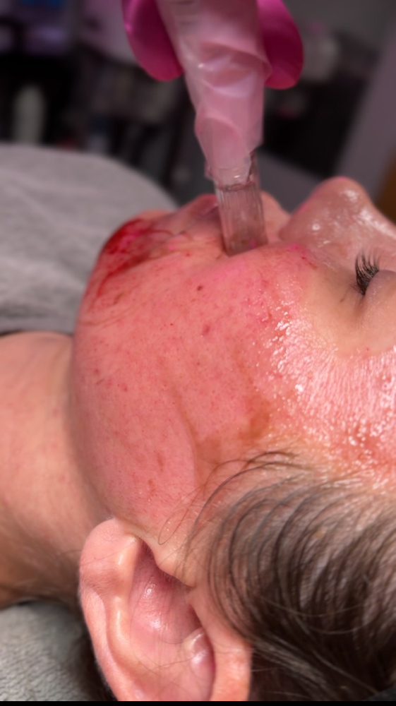 Microneedling Facial