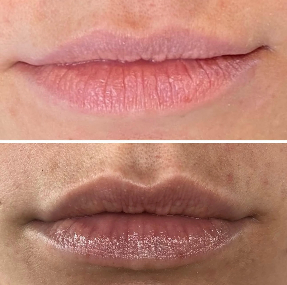 Botox: Lip Flip