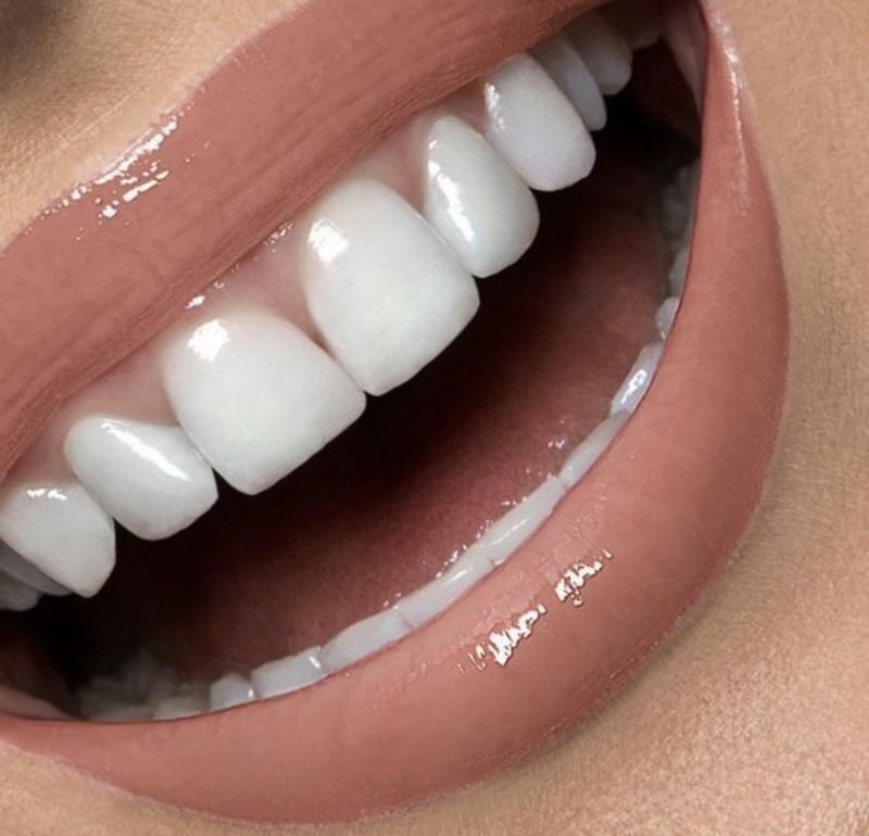 Mother’s Day Teeth  Whitening