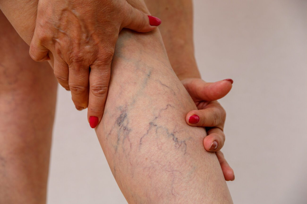 Spider Vein Treatment at Magneto Beauty Studio in Brownsville, TX