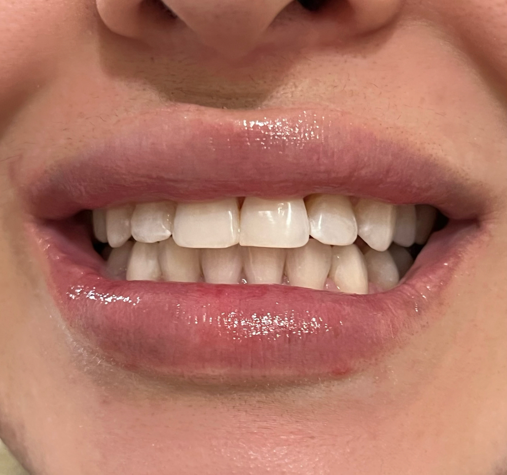 Teeth Whitening 60min