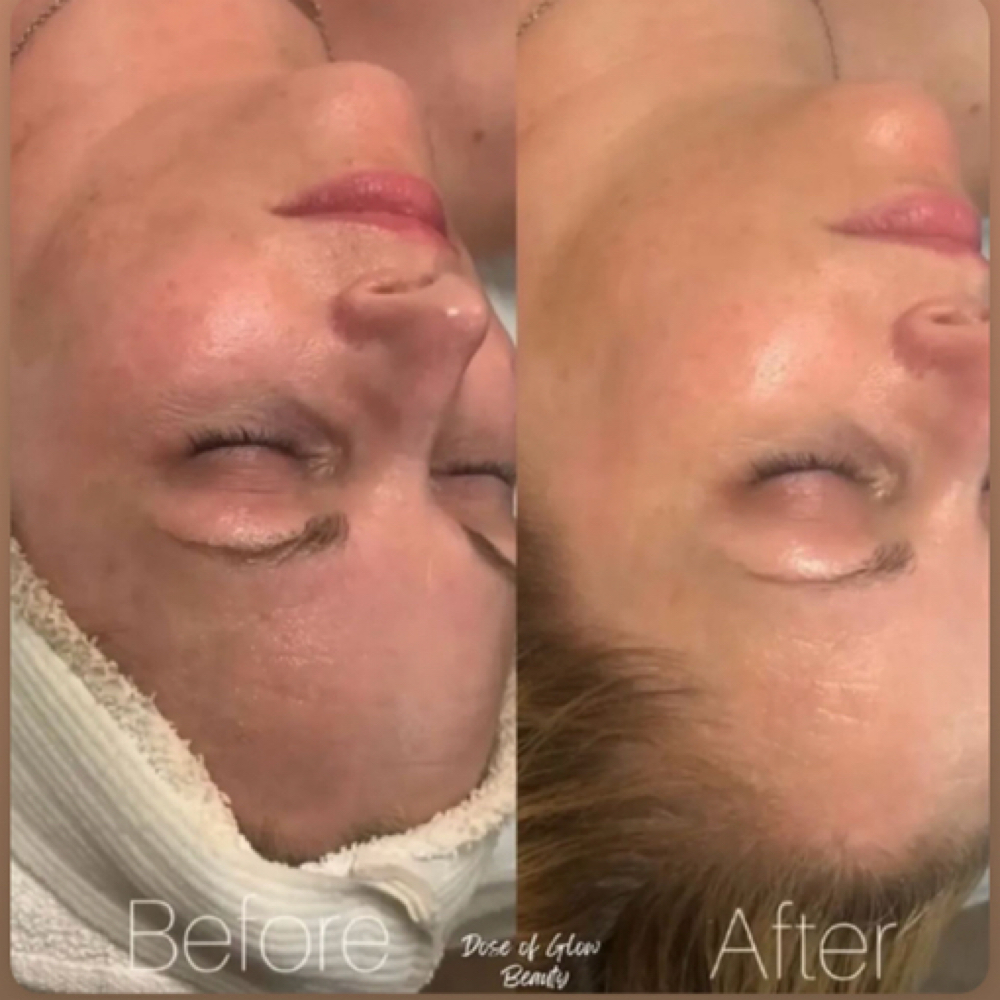 Signature Refresh Facial at Dose of Glow in Phoenix, AZ