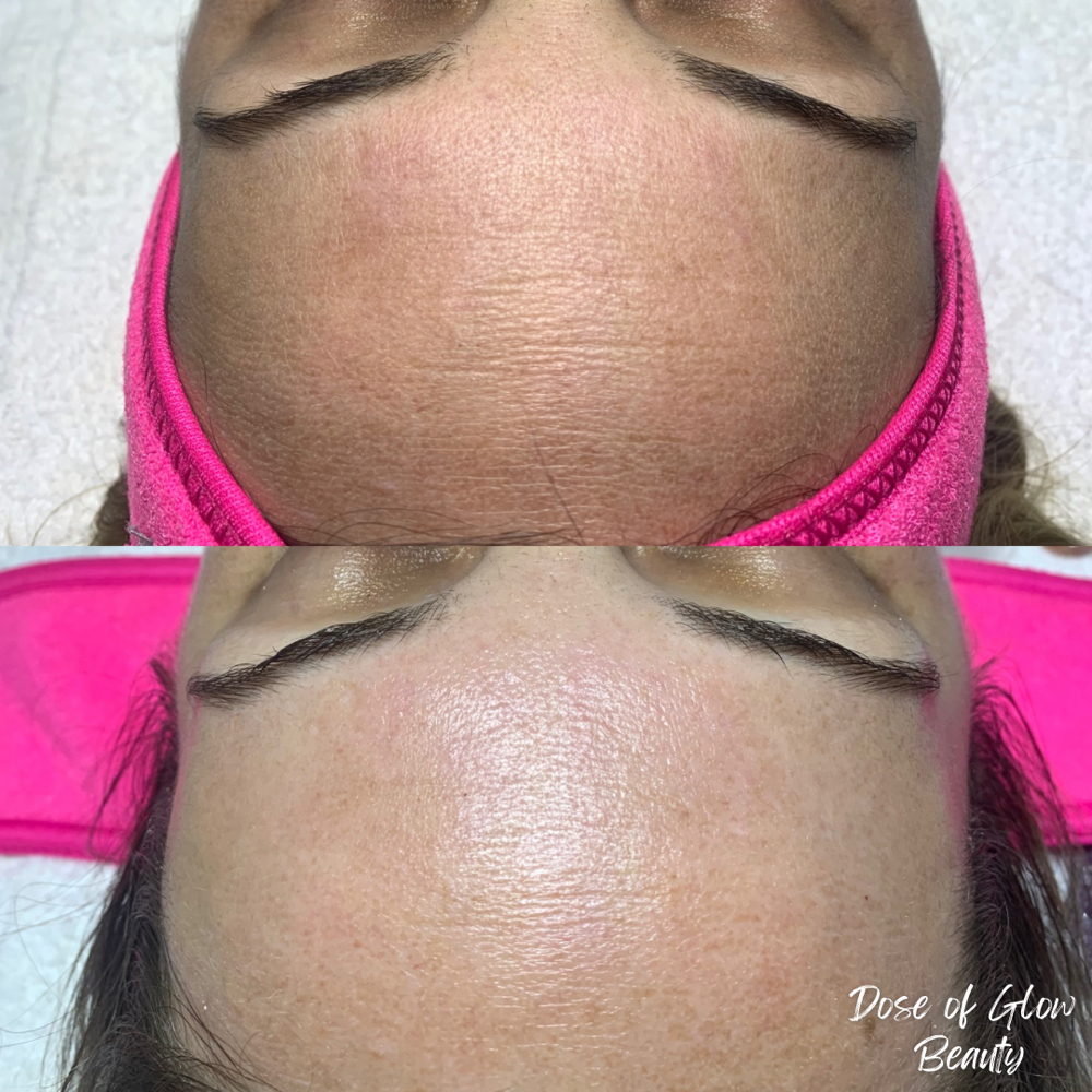 The Refresh Treatment at Dose of Glow in Phoenix, AZ