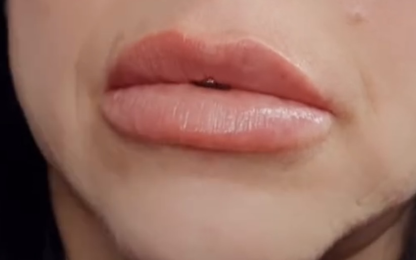 Dermal Fillers at Juiced by Q in Baldwin, NY