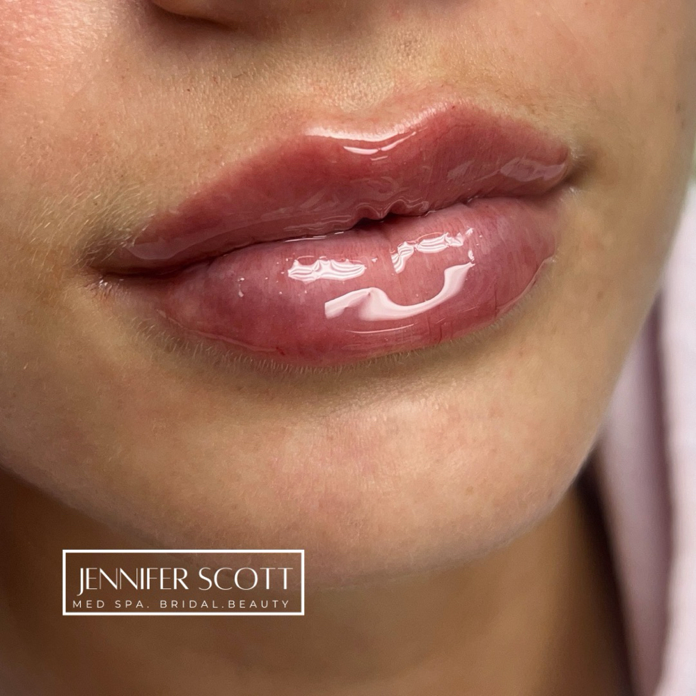 Lip Filler at Jennifer Scott Med Spa in Arnold, MO