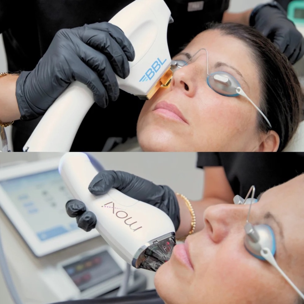 BBL/Moxi Combo at The Skin Concierge in Northbrook, IL