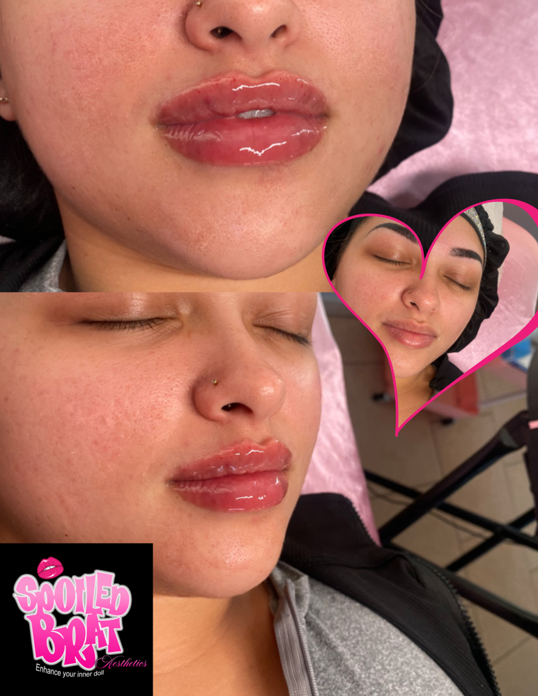 2ML NEEDLESS LIP FILLER