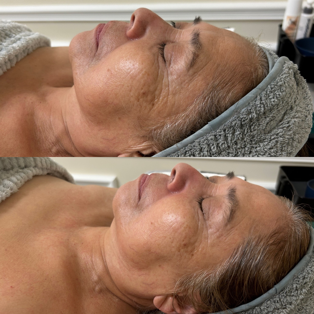 FIRMING PEPTIDE TREATMENT