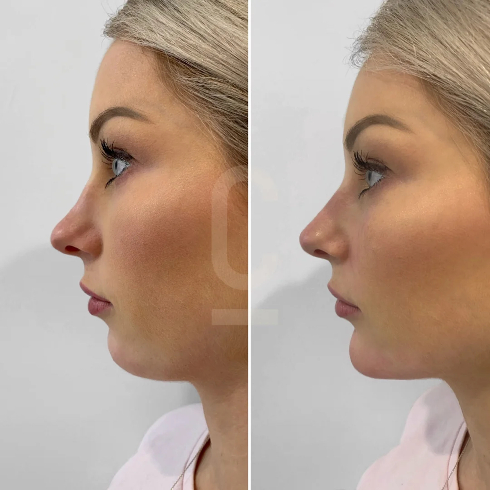 Chin Filler💉