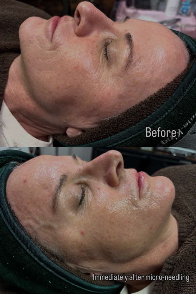 Micro-needling Treatment